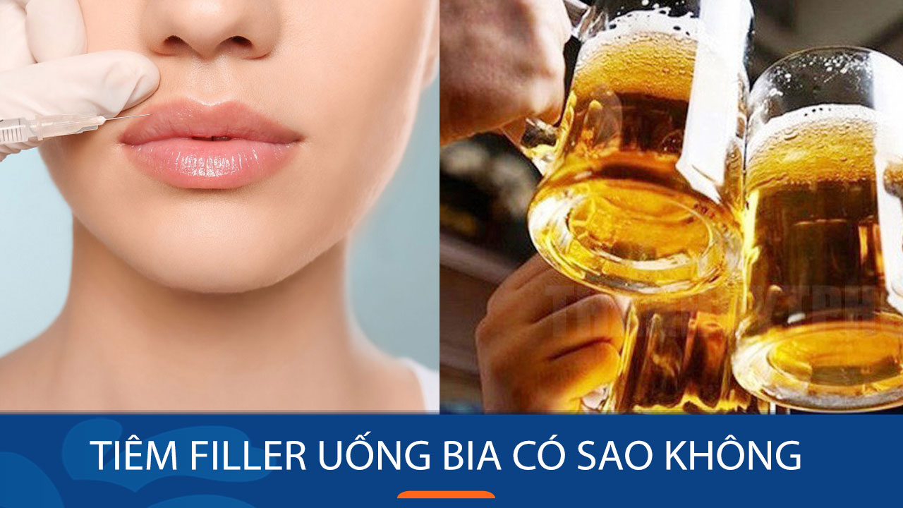 Tiêm filler uống bia có sao không? Nên kiêng thời gian bao lâu