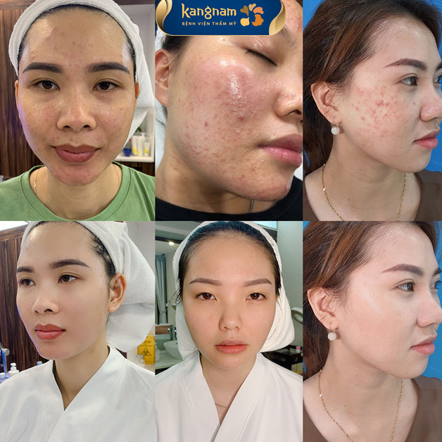 Quá trình trị mụn, lấy lại làn da mịn màng của khách hàng Kangnam