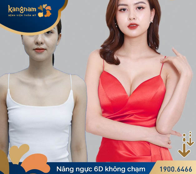 Dịch vụ nâng ngực tân tiến tại Kangnam Nguyễn Trãi