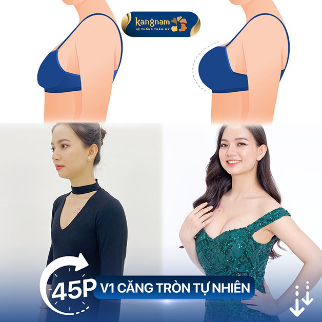 vòng 1 căng tròn, cải thiện rõ rệt sau khi nâng ngực tại Kangnam 
