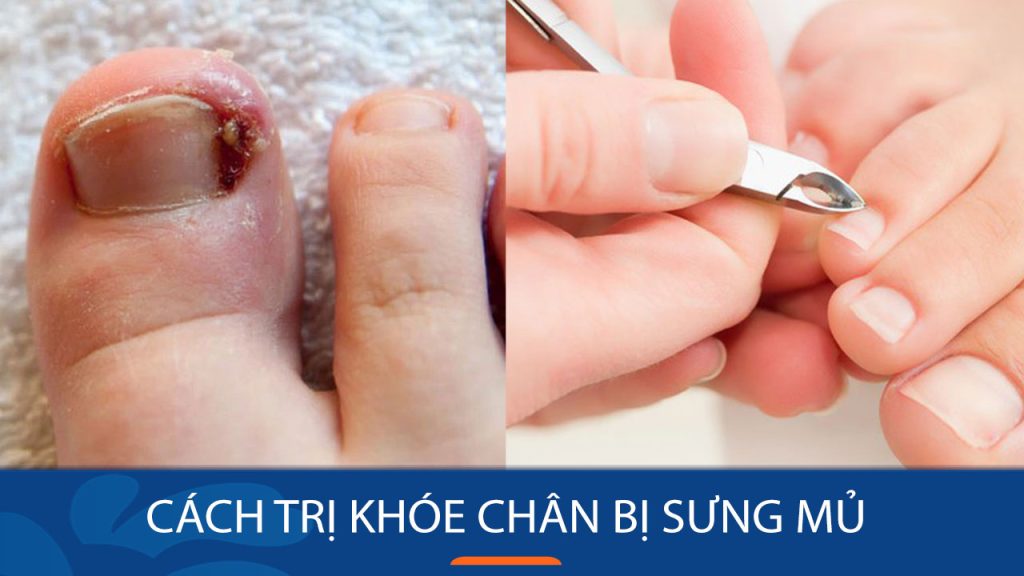 Cách Trị Sưng Mủ ở Khóe Chân: Hướng Dẫn Chi Tiết và Các Biện Pháp Hiệu Quả