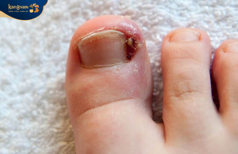Khóe chân có mủ do nhiễm khuẩn