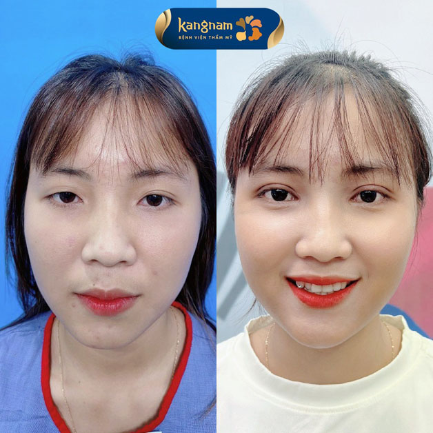 Hình ảnh trước và sau khi cắt mí tại Kangnam