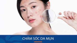 Chăm sóc da mụn: Bí quyết “đánh bay”, trị dứt điểm mụn