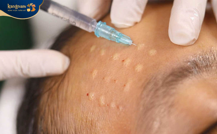 Nếu không chăm sóc da sau tiêm meso có thể gây viêm nhiễm, giảm hiệu quả làm đẹp