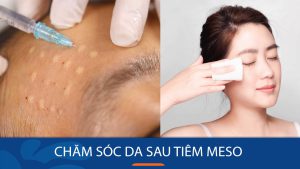 Bí quyết chăm sóc da sau tiêm meso để đạt hiệu quả tối ưu