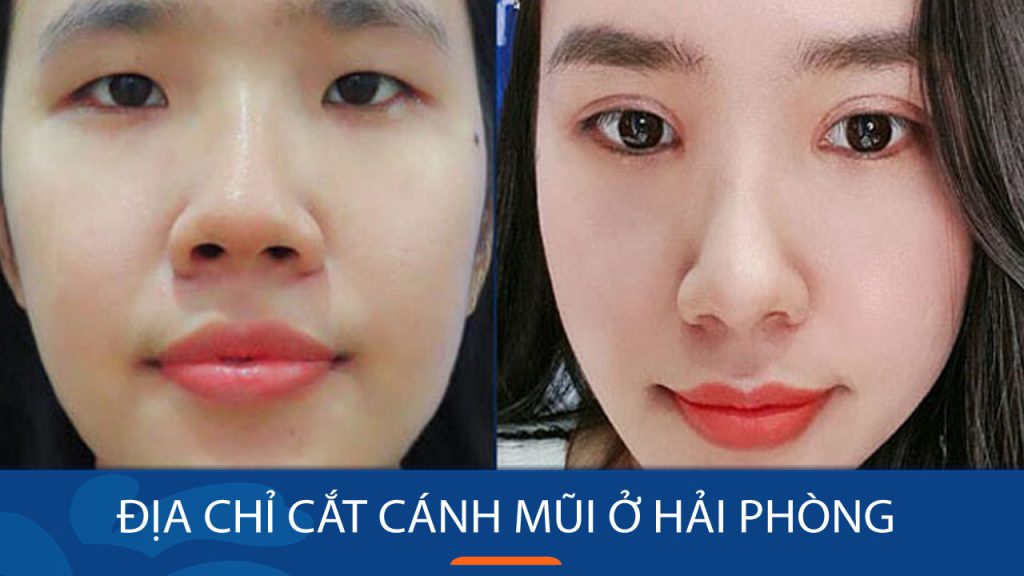 Địa chỉ cắt cánh mũi ở Hải Phòng: ĐẸP – KHÔNG ĐAU – AN TOÀN