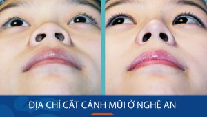 Địa chỉ cắt cánh mũi ở Nghệ An không đau, không sẹo