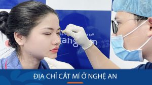 Địa chỉ cắt mí ở Nghệ An thăng hạng vẻ đẹp đôi mắt của bạn