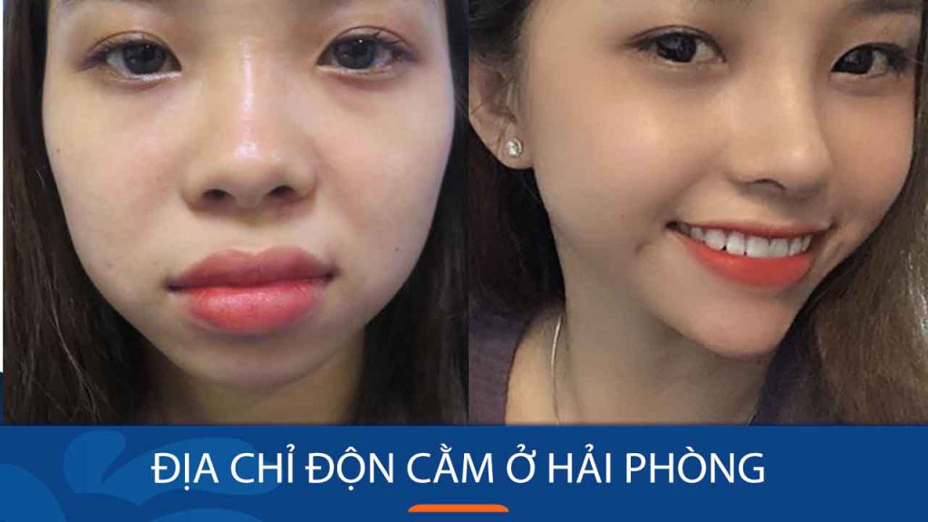 Địa chỉ độn cằm ở Hải Phòng: Gợi Ý địa chỉ uy tín