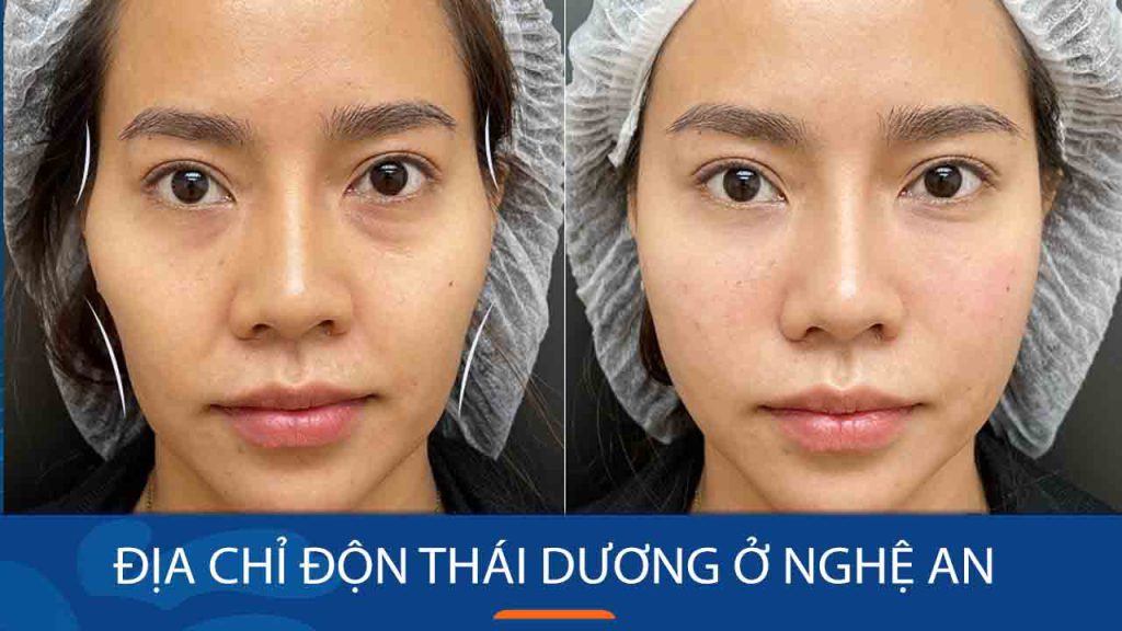 Địa chỉ độn thái dương ở Nghệ An – Vinh, uy tín chất lượng