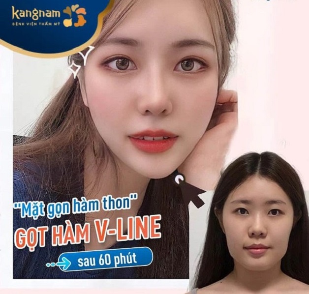 Gọt hàm Vline 3D