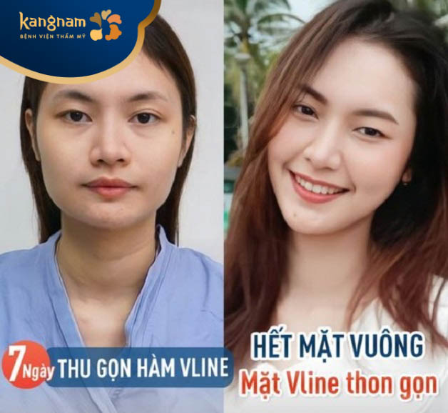 Nhật Minh vui mừng chia sẻ kết quả sau gọt hàm tại Kangnam Hải Phòng