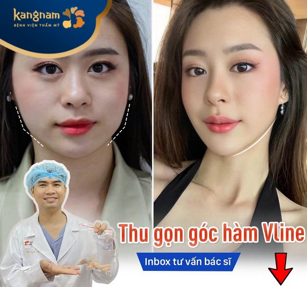 Địa chỉ gọt hàm tại Hải Phòng uy tín - Viện thẩm mỹ Kangnam