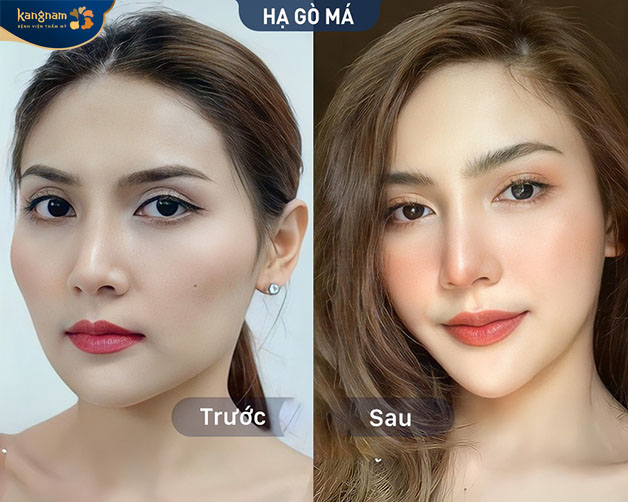 Hình ảnh của khách hàng trước và sau khi thực hiện hạ gò má 