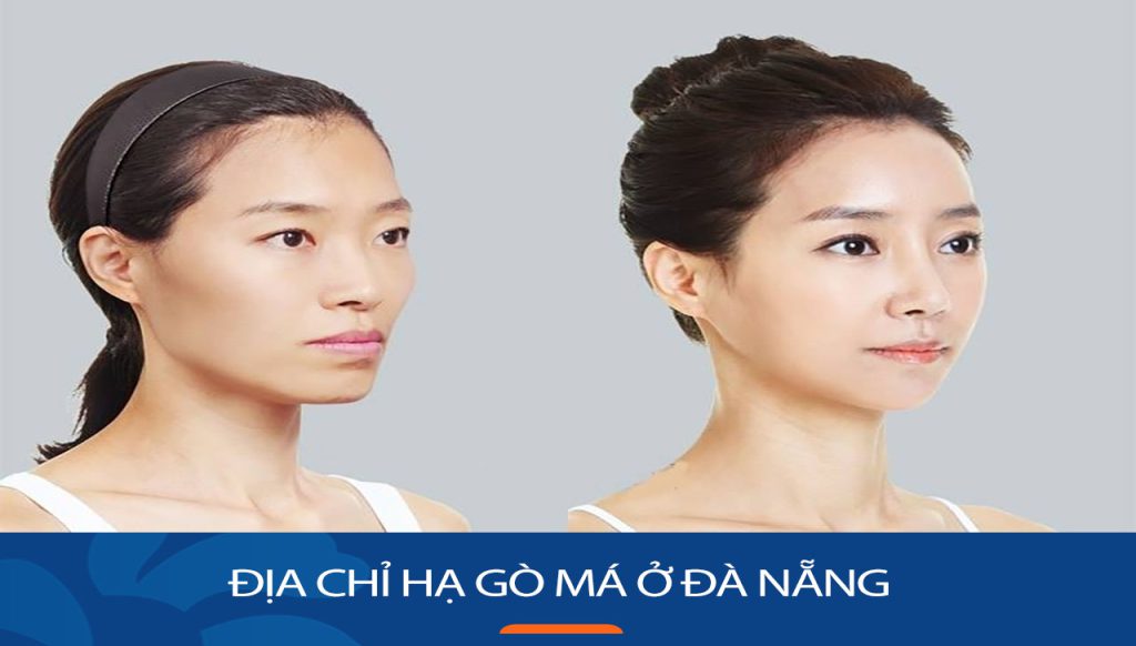 Địa chỉ hạ gò má ở Đà Nẵng an toàn, uy tín