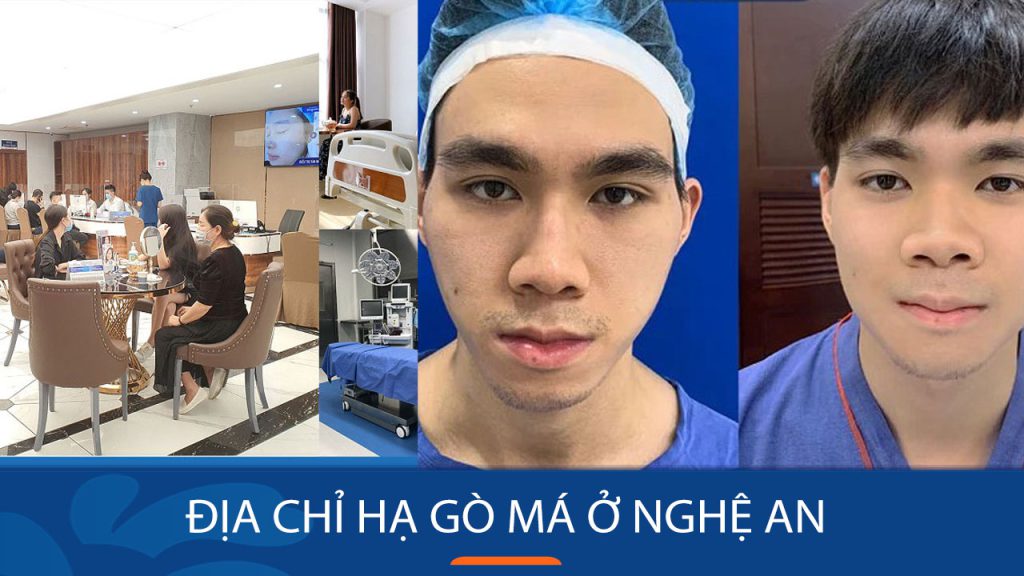 Địa chỉ hạ gò má Kangnam Nghệ An Uy tín – An toàn