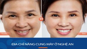 Địa chỉ nâng cung chân mày Kangnam, uy tín nhất tỉnh Nghệ An