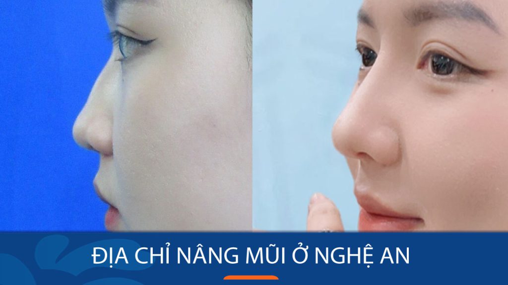 Địa chỉ nâng mũi ở Nghệ An uy tín, nâng mũi siêu nhẹ, bền đẹp