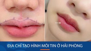 Địa chỉ tạo hình môi tim uy tín nhất ở Hải Phòng