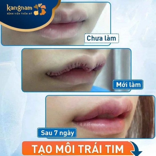 Tạo hình môi tim 6D  tại Kangnam Thanh Hóa