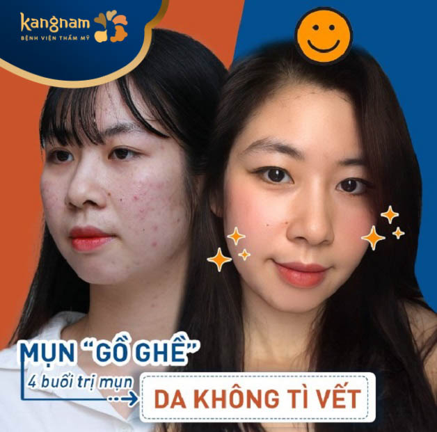 Địa chỉ trị mụn Buôn Ma Thuột - Viện thẩm mỹ Kangnam 