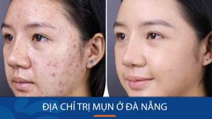 Địa chỉ trị mụn ở Đà Nẵng: Uy Tín, Hiệu Quả