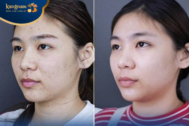 Bạn Nguyễn Tuyết chia sẻ hài lòng với dịch vụ trị mụn của Kangnam