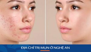 Viện thẩm mỹ Kangnam – Địa chỉ trị mụn ở Nghệ An uy tín