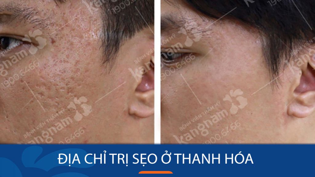 Địa chỉ trị sẹo ở Thanh Hóa tốt nhất hiện nay? Review chi tiết