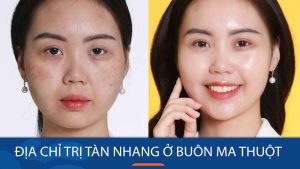 Địa chỉ trị tàn nhang ở Buôn Ma Thuột ĐakLak – Uy Tín Chất lượng