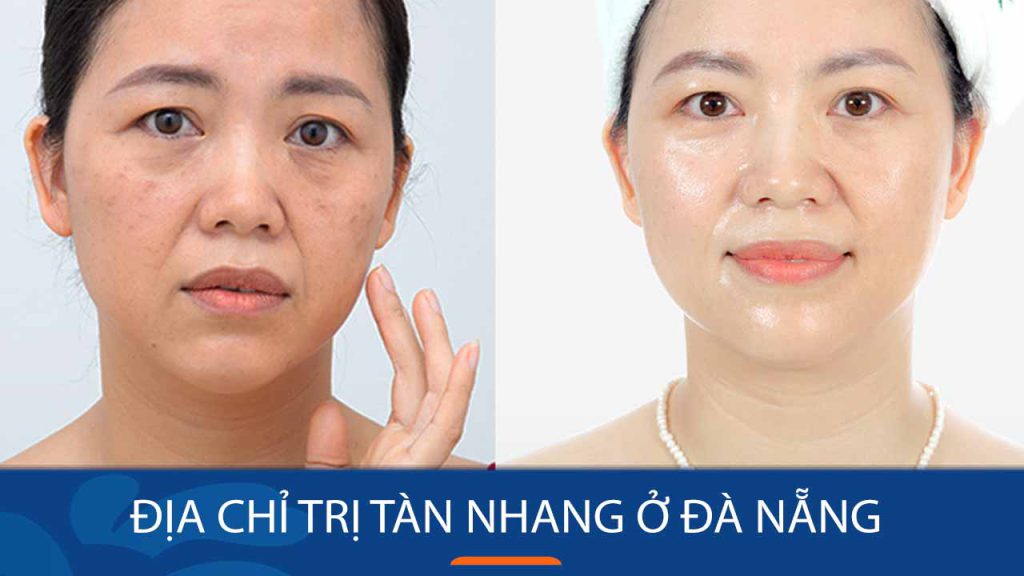 Địa Chỉ Trị Tàn Nhang ở Thái Nguyên Xóa Sạch Tàn Nhang 2808