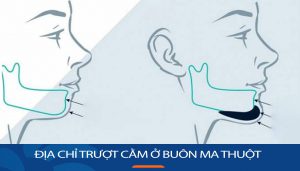 Địa chỉ trượt cằm ở Buôn Ma Thuột đánh bay khuyết điểm