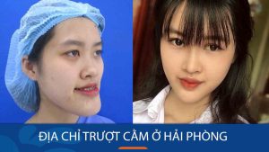 Địa chỉ Trượt cằm ở Hải Phòng: Uy tín – Chất lượng