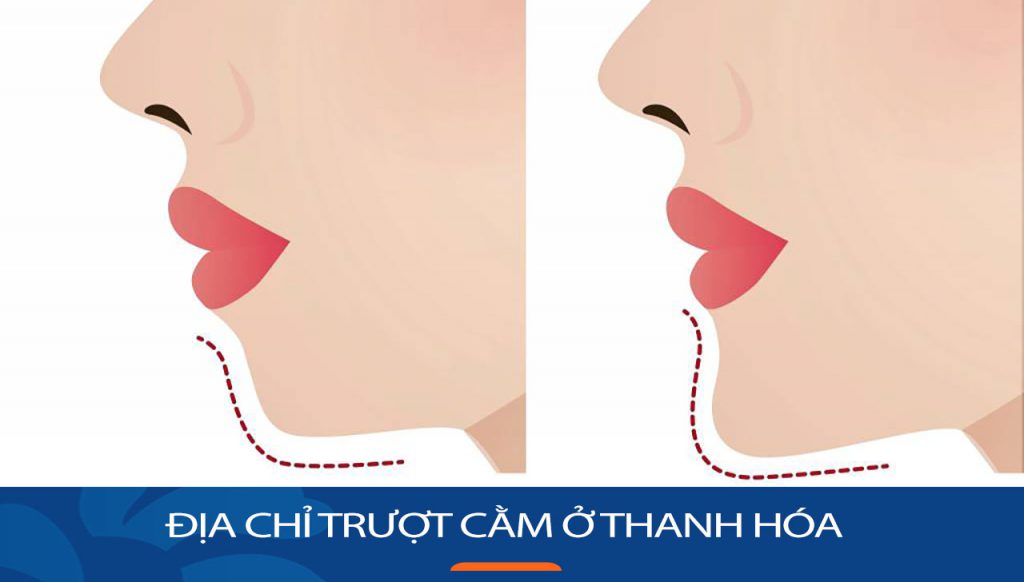 Kangnam – Địa chỉ Trượt cằm ở uy tín và chất lượng tại Thanh Hóa