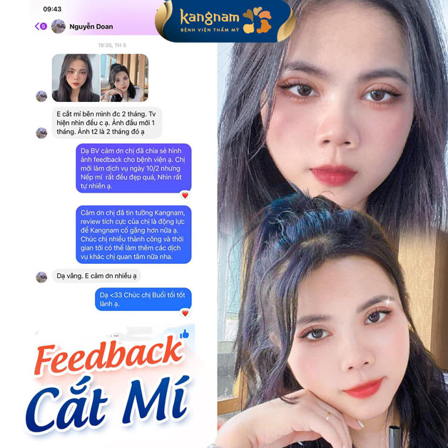 Bạn Nguyễn Doan feedback kết quả cắt mí