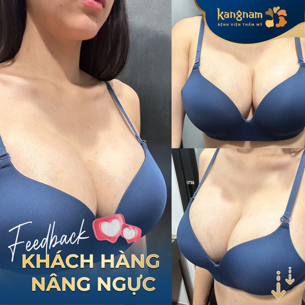 Hình ảnh khách hàng nâng ngực tại Kangnam