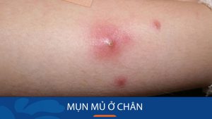 4 Bí quyết loại bỏ mụn mủ ở chân nhanh chóng và dứt điểm