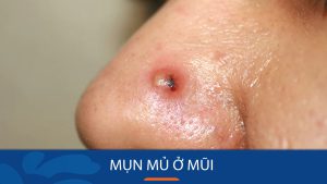 Mụn mủ ở mũi : Bí quyết loại bỏ mụn mủ ở mũi tận gốc