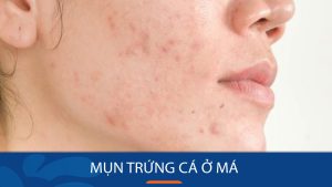 Cách loại bỏ mụn trứng cá ở má vĩnh viễn