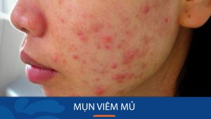 Mụn viêm mủ: Bí quyết loại bỏ mụn viêm mủ tận gốc