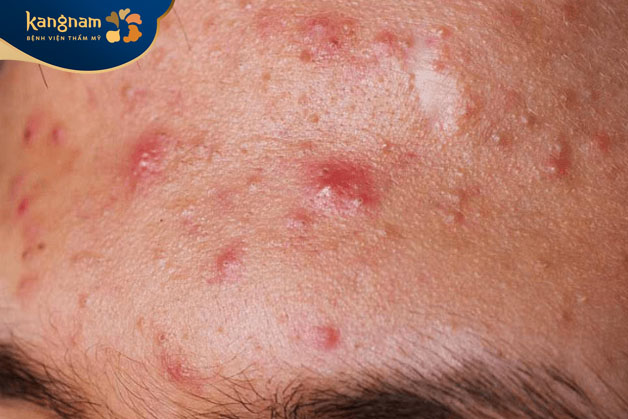 Mụn bọc viêm có chứa mủ có khả năng xuất hiện trên nhiều vùng da khác nhau