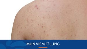 Cách trị mụn viêm ở lưng hiệu quả, dứt điểm: đánh bay mụn viêm ở lưng chỉ trong 7 ngày