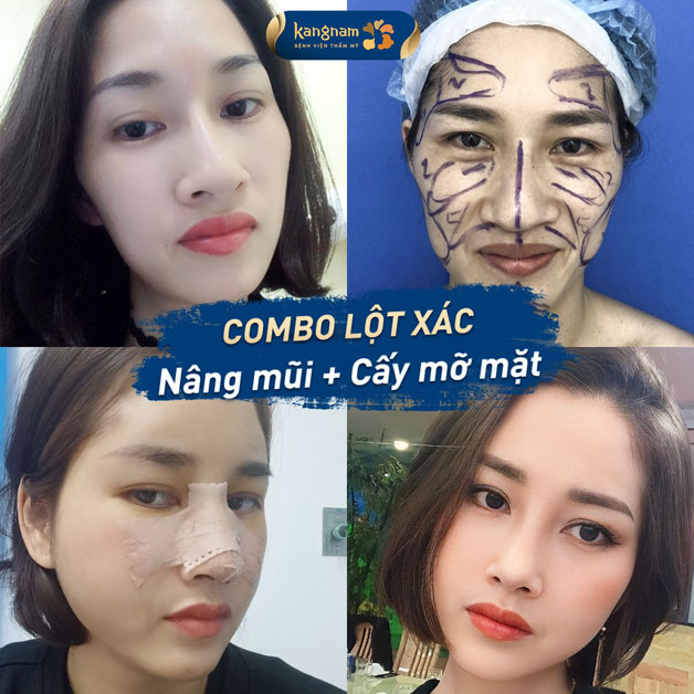 Khách hàng thay đổi diện mạo ngoạn mục sau combo nâng mũi + cấy mỡ mặt tại Kangnam