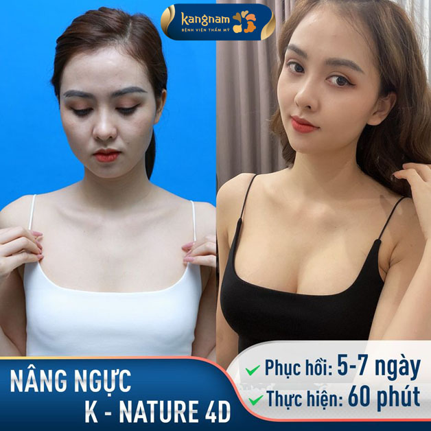 Nâng ngực K-Nature 4D - Vẻ đẹp tự nhiên, hoàn hảo