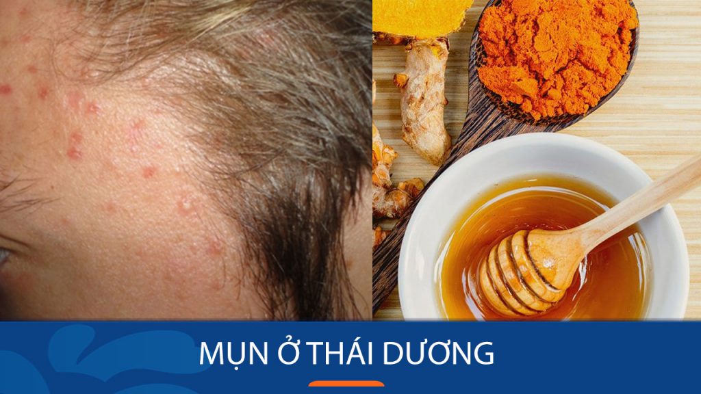 Mụn ở thái dương: Bí quyết trị mụn ở thái dương dứt điểm