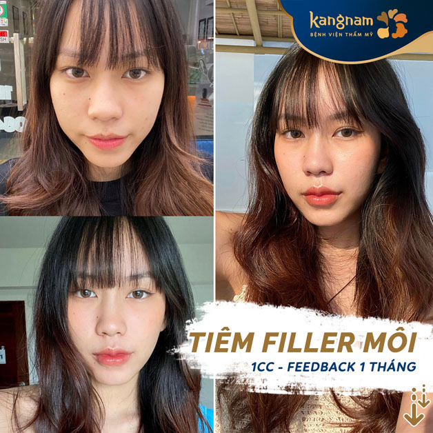 Tiêm filler môi đầy đặn, quyến rũ