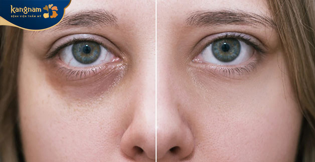 Vùng thâm mắt được cải thiện ngay chỉ trong 1 liệu trình 