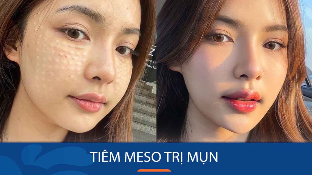 Tiêm meso trị mụn – Giải pháp hoàn hảo cho làn da sáng mịn