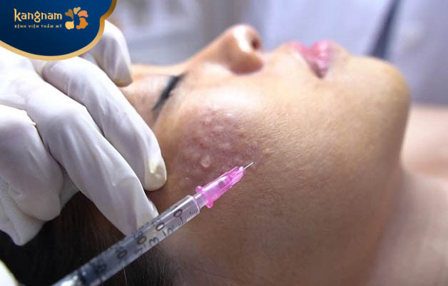 Phương pháp tiêm meso điều trị nám da là gì